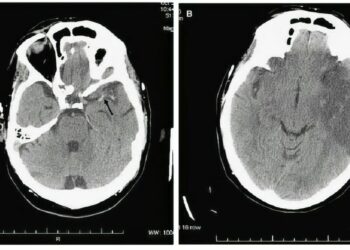 Fuerteventura ya cuenta con un tratamiento innovador para el ictus agudo