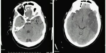 Fuerteventura ya cuenta con un tratamiento innovador para el ictus agudo