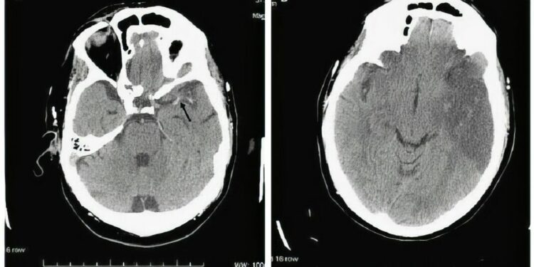 Fuerteventura ya cuenta con un tratamiento innovador para el ictus agudo