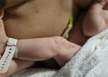 Sanidad amplía el cribado neonatal a 31 enfermedades raras